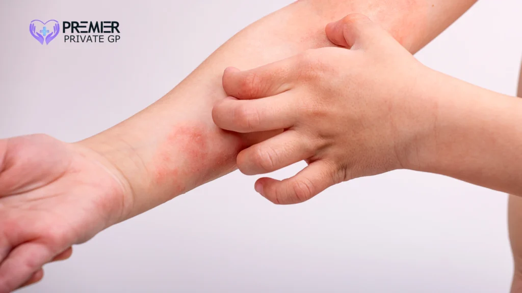 Close-up of child’s hands showing dry, scaly eczema symptoms, often linked to atopic dermatitis.