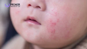 Eczema rash in a child