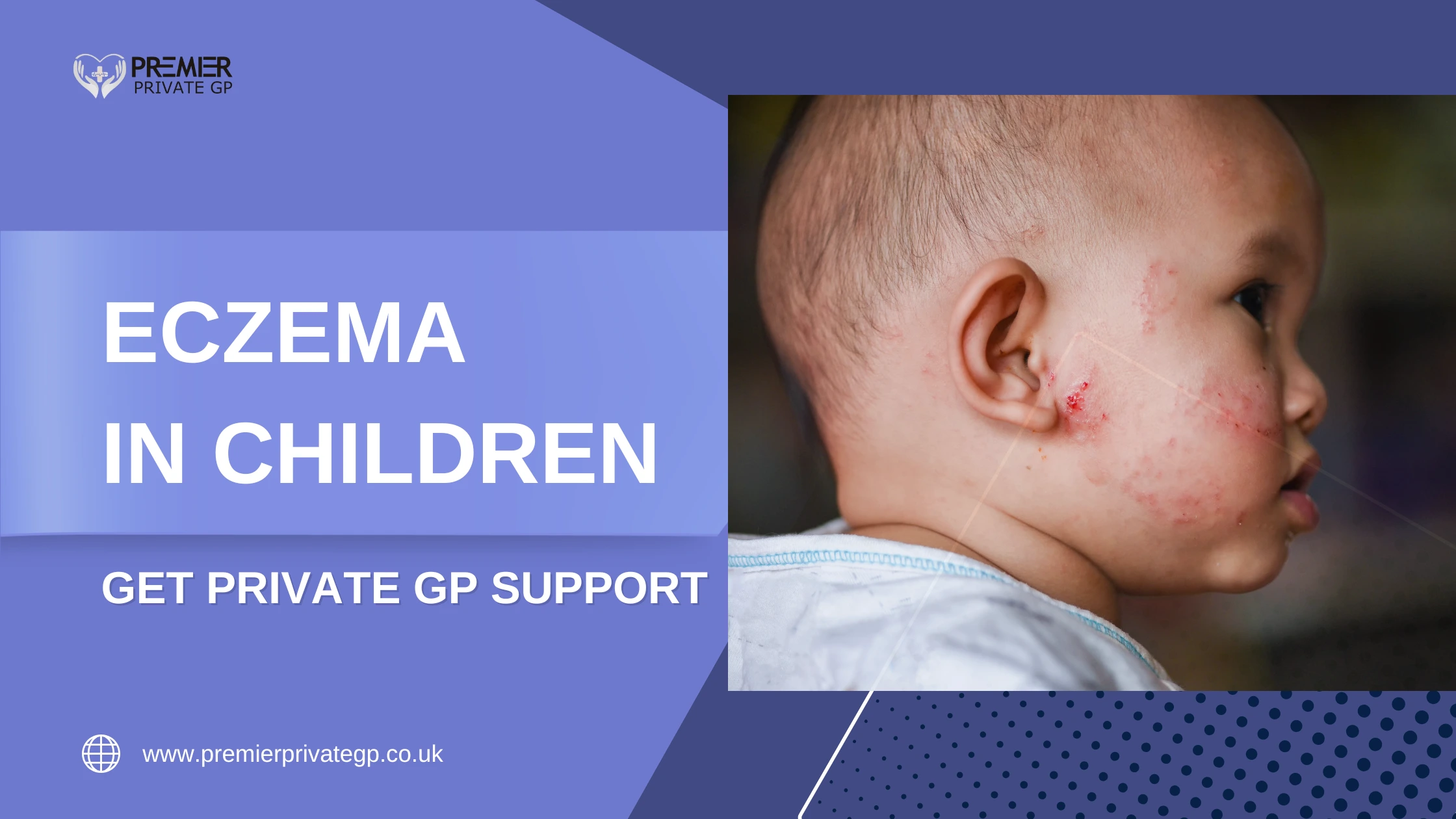 Close-up of child’s hands showing dry, scaly eczema symptoms, often linked to atopic dermatitis.